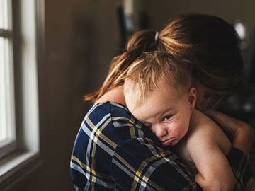 Maminka držící male dítě s ekzémem na tváři